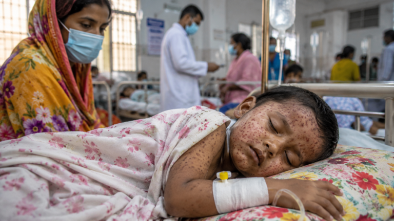হামের উপসর্গে আরও ৩ শিশুর মৃত্যু, মৃতের সংখ্যা বেড়ে ৭৪১